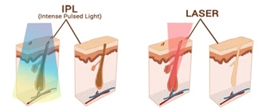 IPL vs. Laser: Nepotřebují oba stejně přísná bezpečnostní opatření?